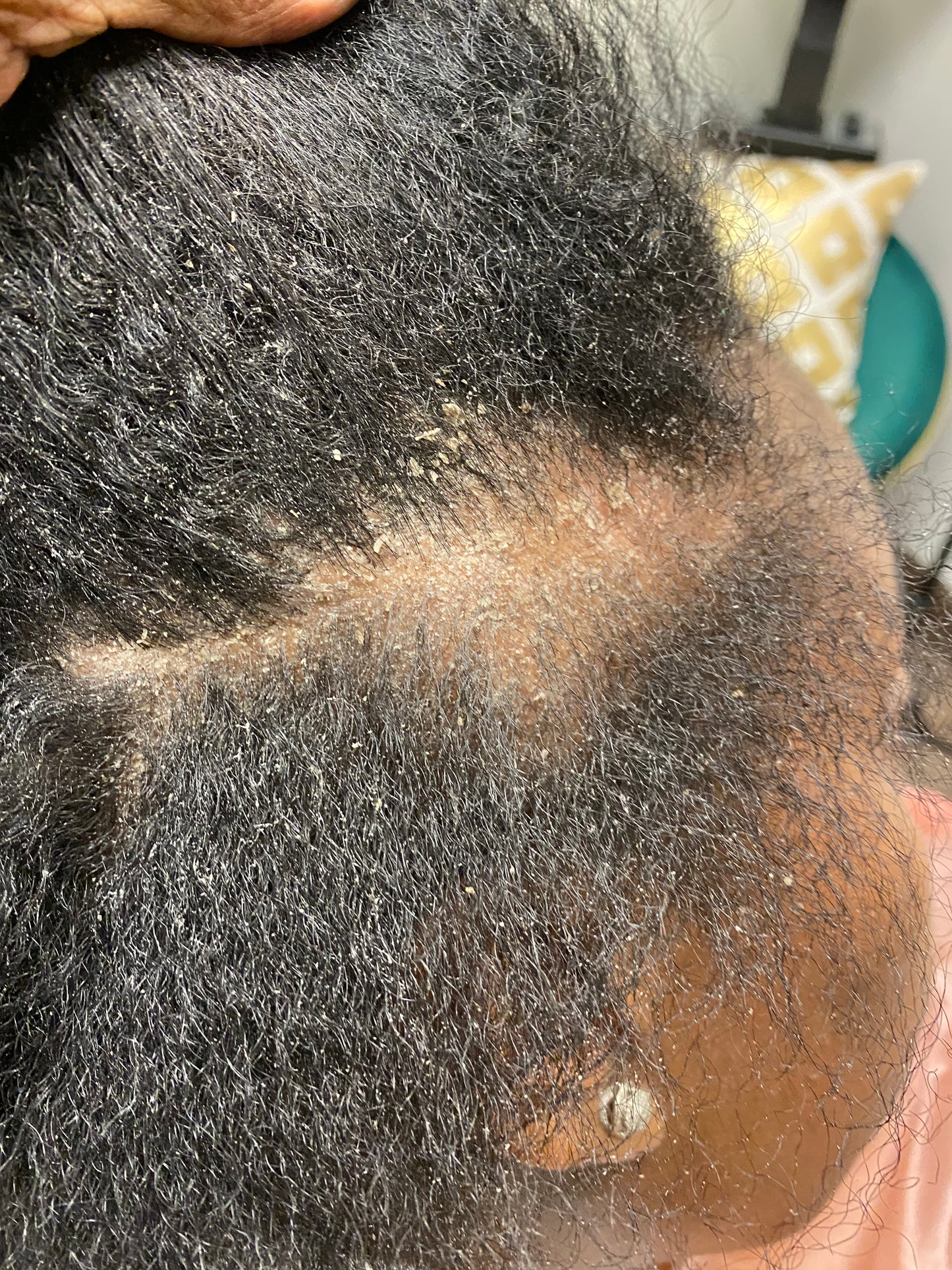 Scalp Eczema and Psoriasis Treatment